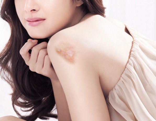 Bà mẹ Pháp “liều” trị bỏng nặng cho con theo cách dân gian, hiệu quả bất ngờ