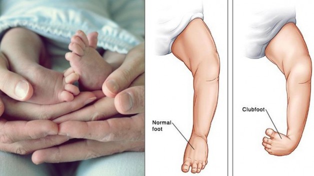 Mẹo giúp bé hết vòng kiềng, chân thẳng tắp trở lại