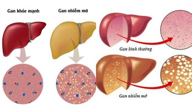 Cảnh báo: 10 nguy cơ và dấu hiệu bệnh gan